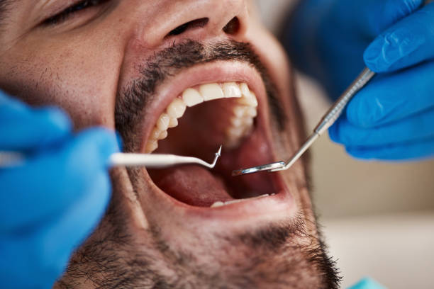 Best Emergency Wisdom Teeth Removal in Colorado City, AZ